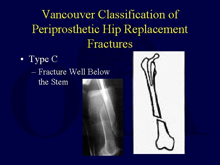 Vancouver Classification of Periprosthetic Hip Replacement Fractures • Type C – Fracture Well Below