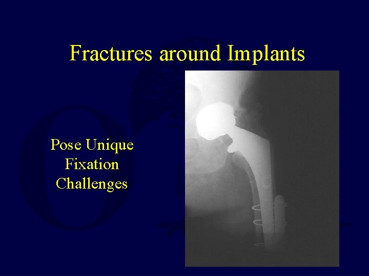 Fractures around Implants Pose Unique Fixation Challenges 