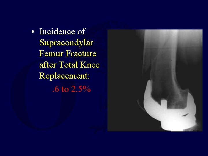  • Incidence of Supracondylar Femur Fracture after Total Knee Replacement: . 6 to