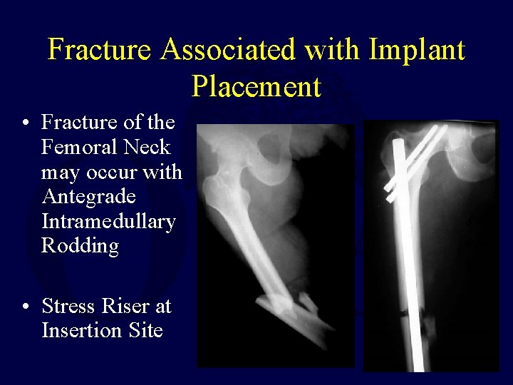 Fracture Associated with Implant Placement • Fracture of the Femoral Neck may occur with