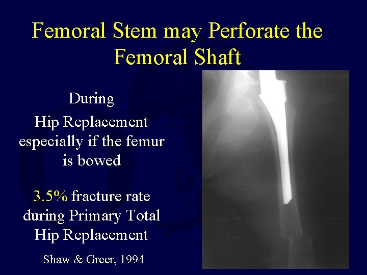 Femoral Stem may Perforate the Femoral Shaft During Hip Replacement especially if the femur