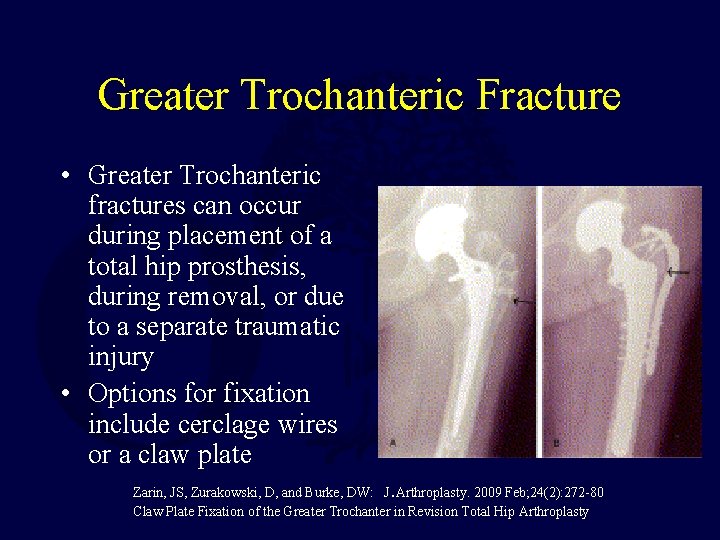 Greater Trochanteric Fracture • Greater Trochanteric fractures can occur during placement of a total