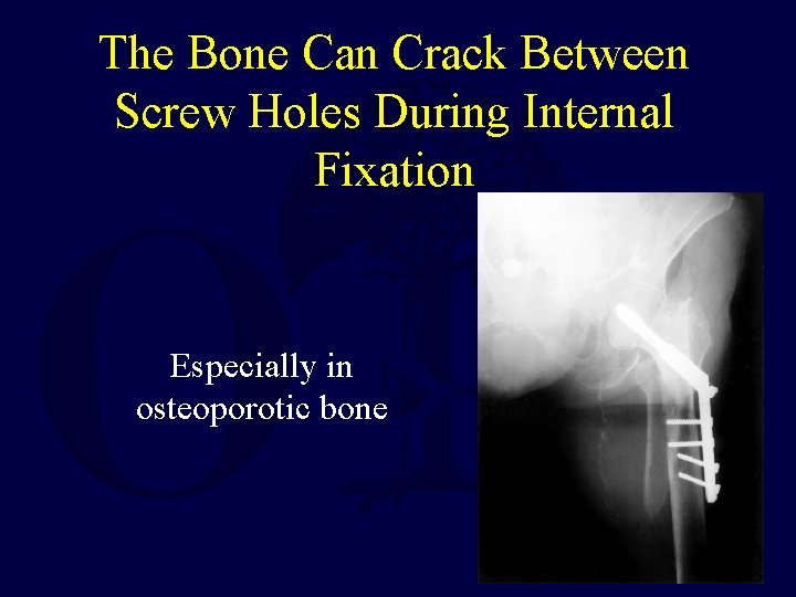 The Bone Can Crack Between Screw Holes During Internal Fixation Especially in osteoporotic bone