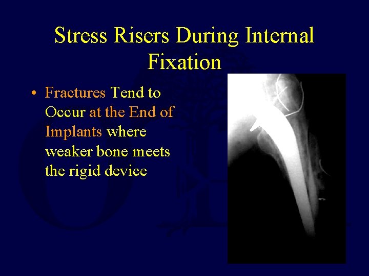 Stress Risers During Internal Fixation • Fractures Tend to Occur at the End of