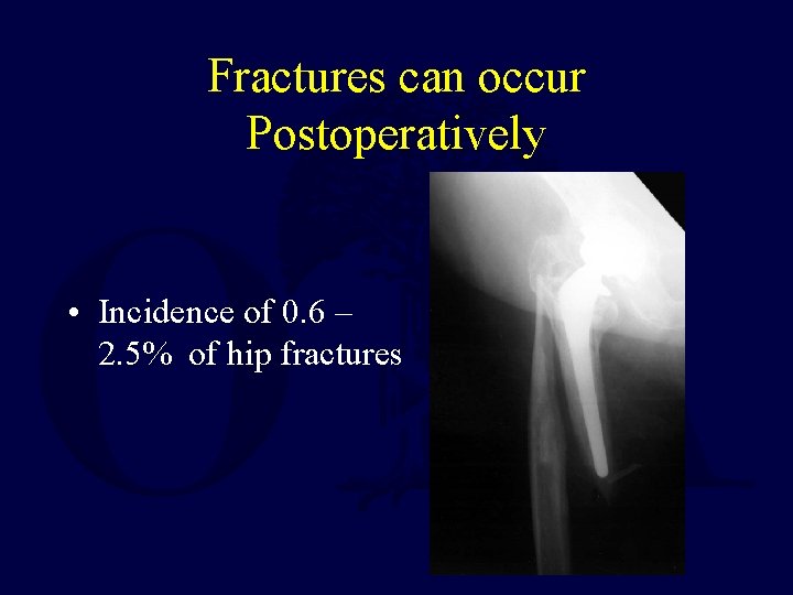 Fractures can occur Postoperatively • Incidence of 0. 6 – 2. 5% of hip