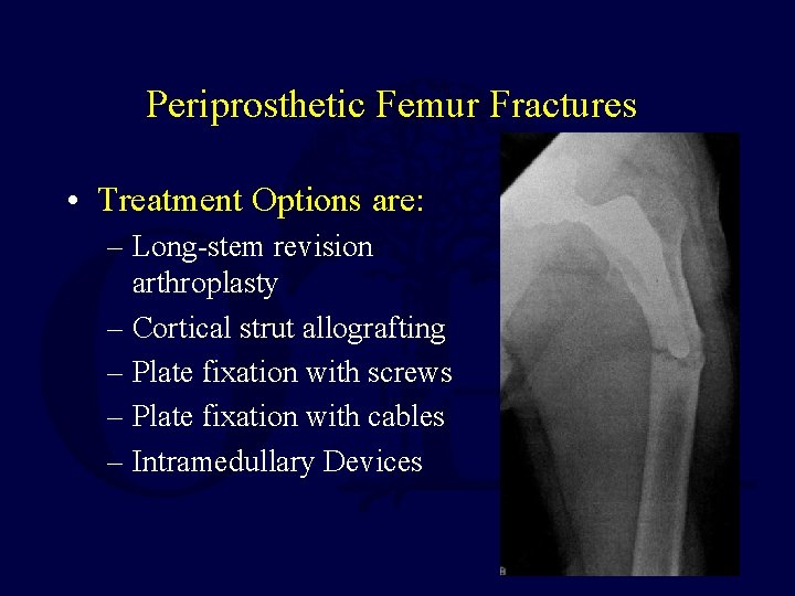 Periprosthetic Femur Fractures • Treatment Options are: – Long-stem revision arthroplasty – Cortical strut