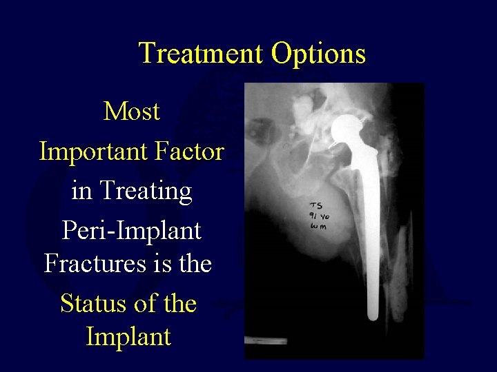 Treatment Options Most Important Factor in Treating Peri-Implant Fractures is the Status of the