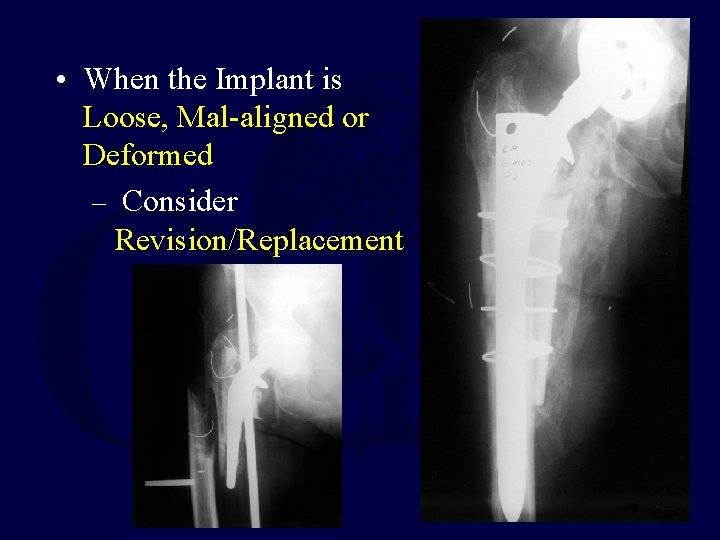  • When the Implant is Loose, Mal-aligned or Deformed – Consider Revision/Replacement 