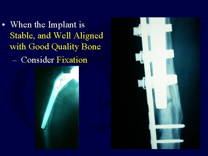  • When the Implant is Stable, and Well Aligned with Good Quality Bone