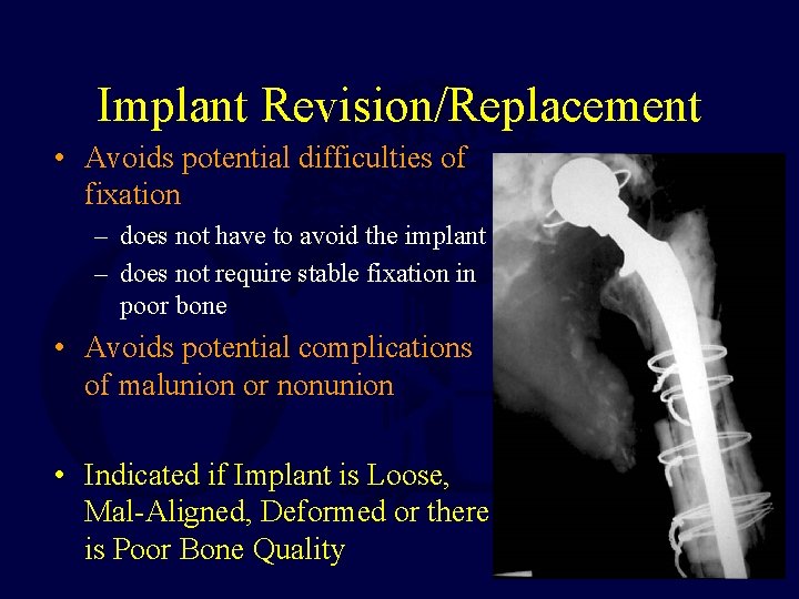 Implant Revision/Replacement • Avoids potential difficulties of fixation – does not have to avoid