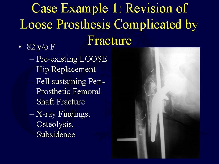 Case Example 1: Revision of Loose Prosthesis Complicated by Fracture • 82 y/o F