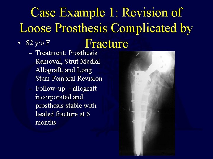 Case Example 1: Revision of Loose Prosthesis Complicated by • 82 y/o F Fracture