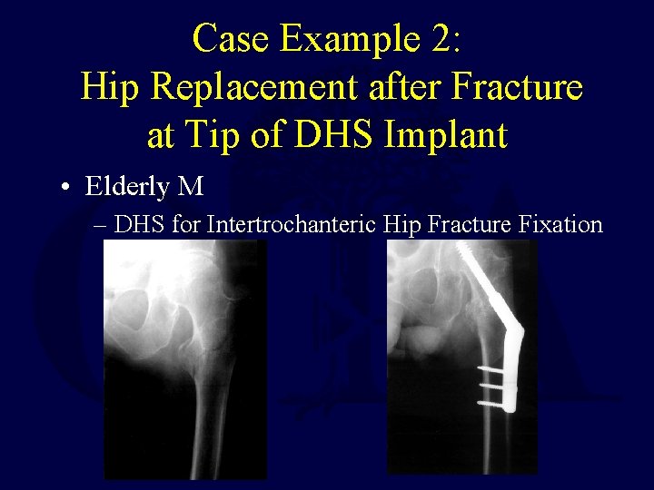 Case Example 2: Hip Replacement after Fracture at Tip of DHS Implant • Elderly