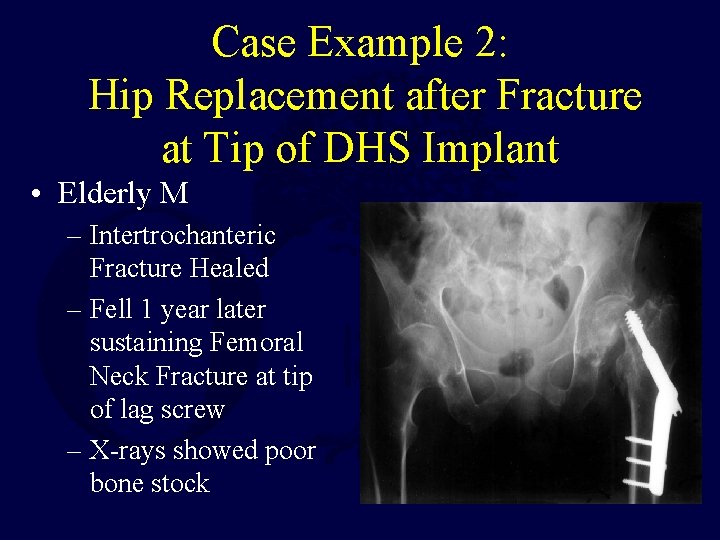 Case Example 2: Hip Replacement after Fracture at Tip of DHS Implant • Elderly