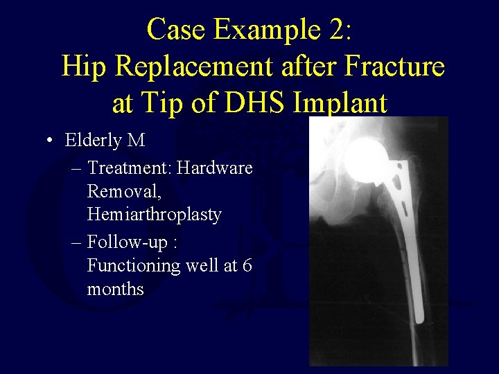 Case Example 2: Hip Replacement after Fracture at Tip of DHS Implant • Elderly