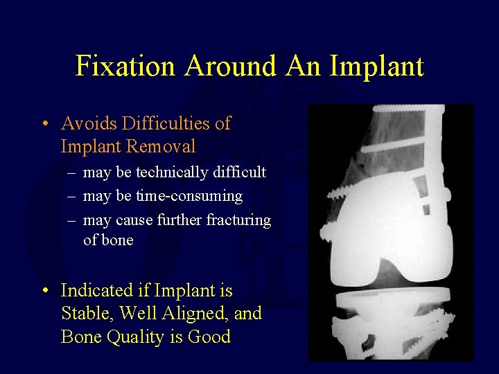Fixation Around An Implant • Avoids Difficulties of Implant Removal – may be technically