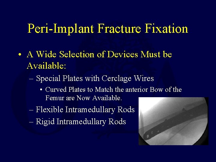 Peri-Implant Fracture Fixation • A Wide Selection of Devices Must be Available: – Special