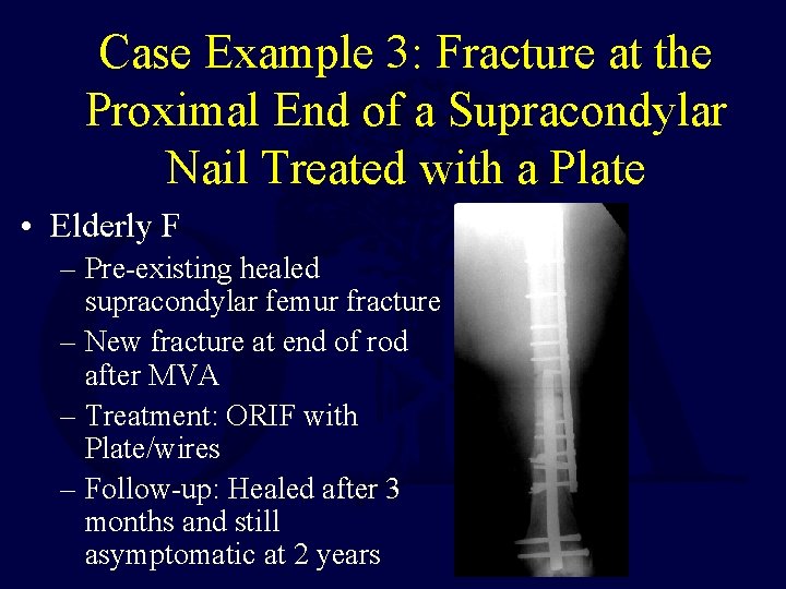 Case Example 3: Fracture at the Proximal End of a Supracondylar Nail Treated with