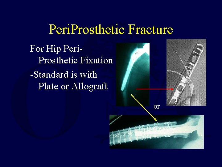 Peri. Prosthetic Fracture For Hip Peri. Prosthetic Fixation -Standard is with Plate or Allograft