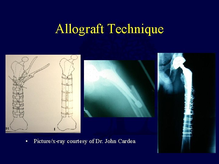 Allograft Technique • Picture/x-ray courtesy of Dr. John Cardea 