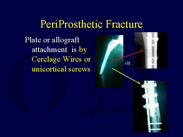 Peri. Prosthetic Fracture Plate or allograft attachment is by Cerclage Wires or unicortical screws