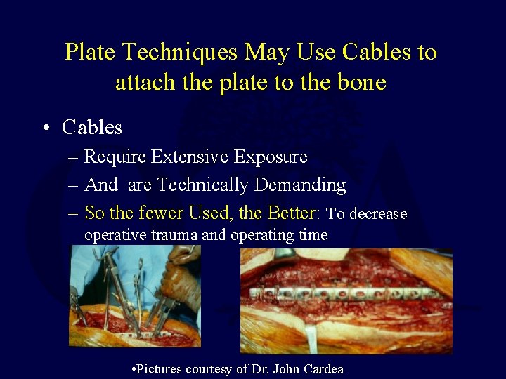 Plate Techniques May Use Cables to attach the plate to the bone • Cables