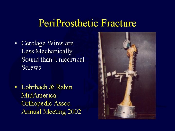 Peri. Prosthetic Fracture • Cerclage Wires are Less Mechanically Sound than Unicortical Screws •