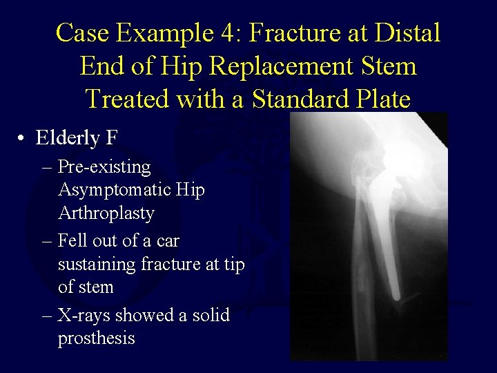 Case Example 4: Fracture at Distal End of Hip Replacement Stem Treated with a