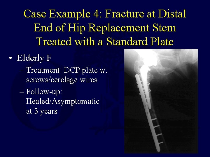 Case Example 4: Fracture at Distal End of Hip Replacement Stem Treated with a