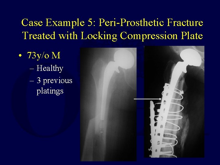 Case Example 5: Peri-Prosthetic Fracture Treated with Locking Compression Plate • 73 y/o M