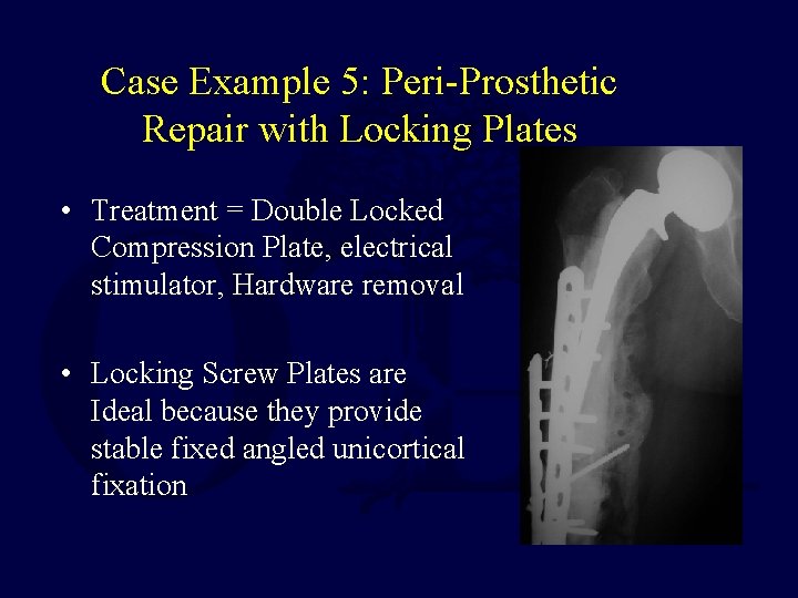 Case Example 5: Peri-Prosthetic Repair with Locking Plates • Treatment = Double Locked Compression