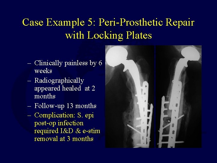 Case Example 5: Peri-Prosthetic Repair with Locking Plates – Clinically painless by 6 weeks