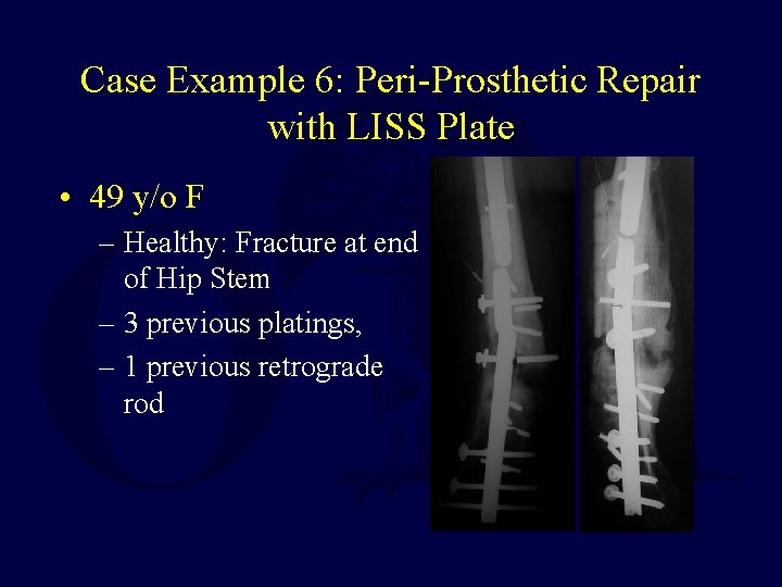 Case Example 6: Peri-Prosthetic Repair with LISS Plate • 49 y/o F – Healthy: