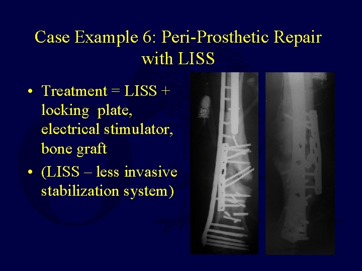 Case Example 6: Peri-Prosthetic Repair with LISS • Treatment = LISS + locking plate,