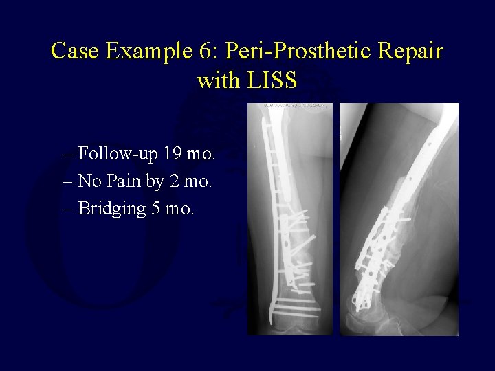 Case Example 6: Peri-Prosthetic Repair with LISS – Follow-up 19 mo. – No Pain