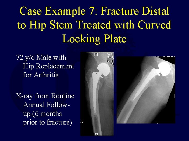 Case Example 7: Fracture Distal to Hip Stem Treated with Curved Locking Plate 72 Case Example 7: Fracture Distal to Hip Stem Treated with Curved Locking Plate 72