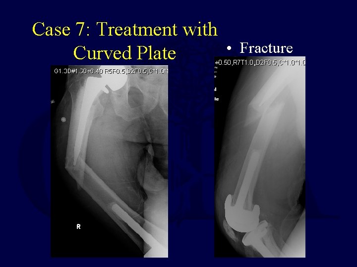 Case 7: Treatment with • Curved Plate Fracture 