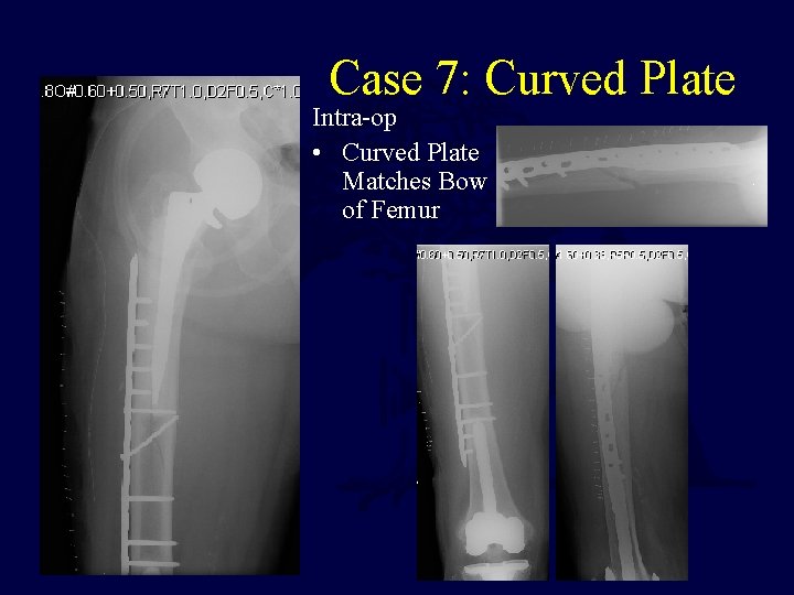 Case 7: Curved Plate Intra-op • Curved Plate Matches Bow of Femur 