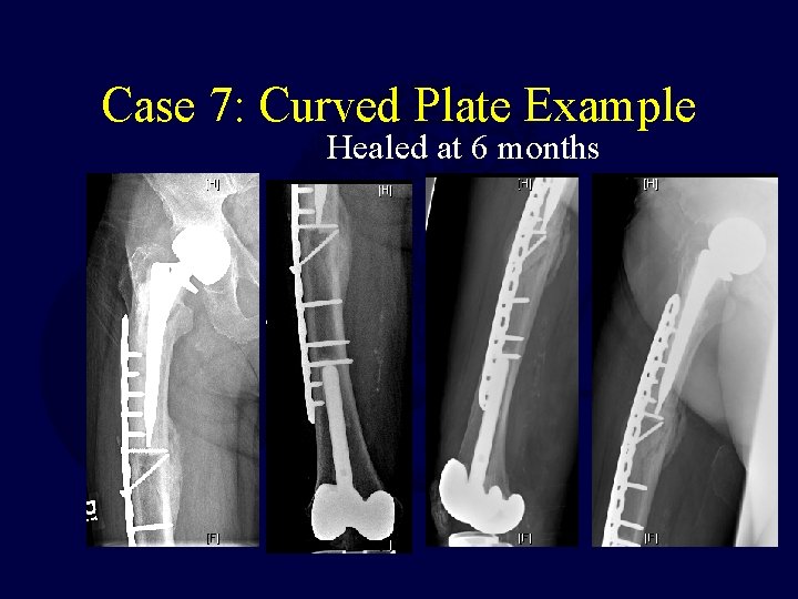 Case 7: Curved Plate Example Healed at 6 months 