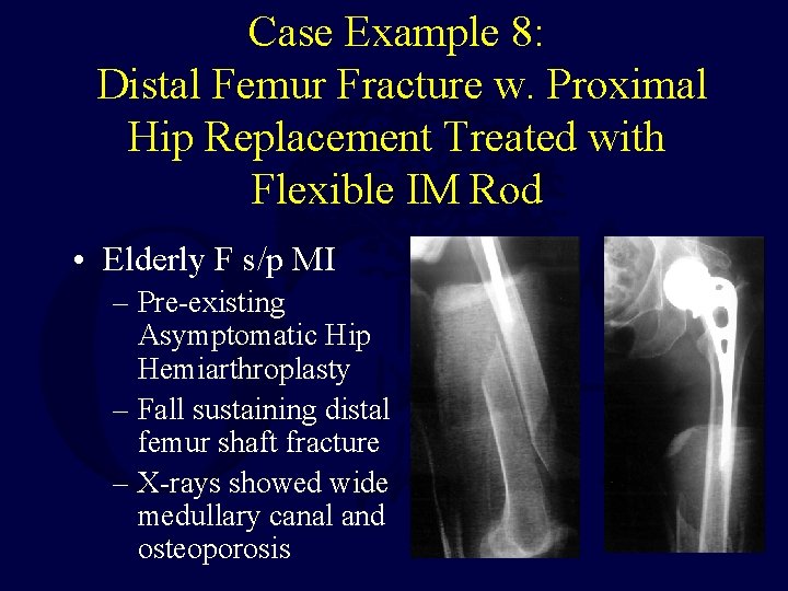 Case Example 8: Distal Femur Fracture w. Proximal Hip Replacement Treated with Flexible IM