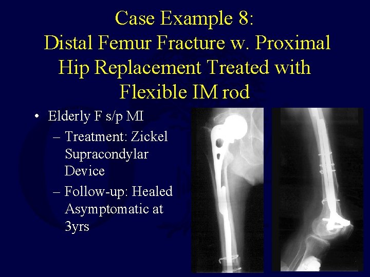 Case Example 8: Distal Femur Fracture w. Proximal Hip Replacement Treated with Flexible IM