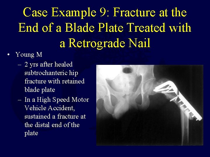 Case Example 9: Fracture at the End of a Blade Plate Treated with a