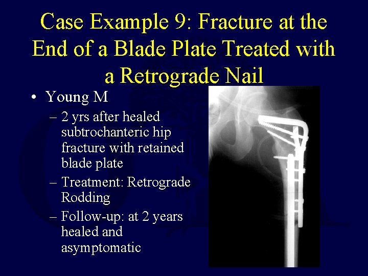 Case Example 9: Fracture at the End of a Blade Plate Treated with a