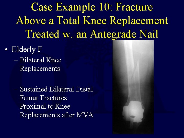 Case Example 10: Fracture Above a Total Knee Replacement Treated w. an Antegrade Nail