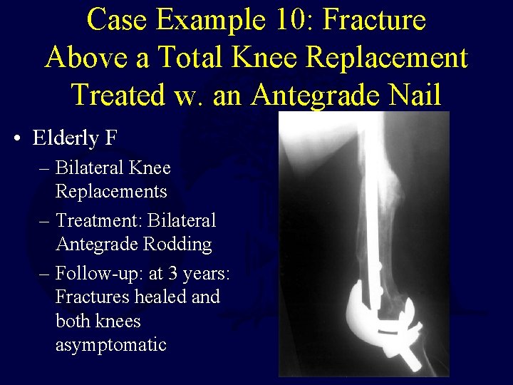 Case Example 10: Fracture Above a Total Knee Replacement Treated w. an Antegrade Nail