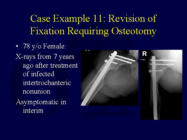 Case Example 11: Revision of Fixation Requiring Osteotomy • 78 y/o Female: X-rays from