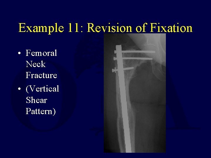 Example 11: Revision of Fixation • Femoral Neck Fracture • (Vertical Shear Pattern) 