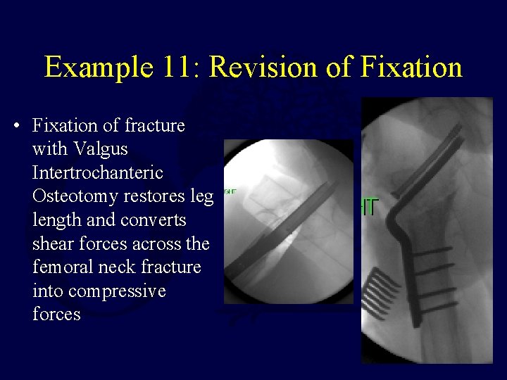 Example 11: Revision of Fixation • Fixation of fracture with Valgus Intertrochanteric Osteotomy restores