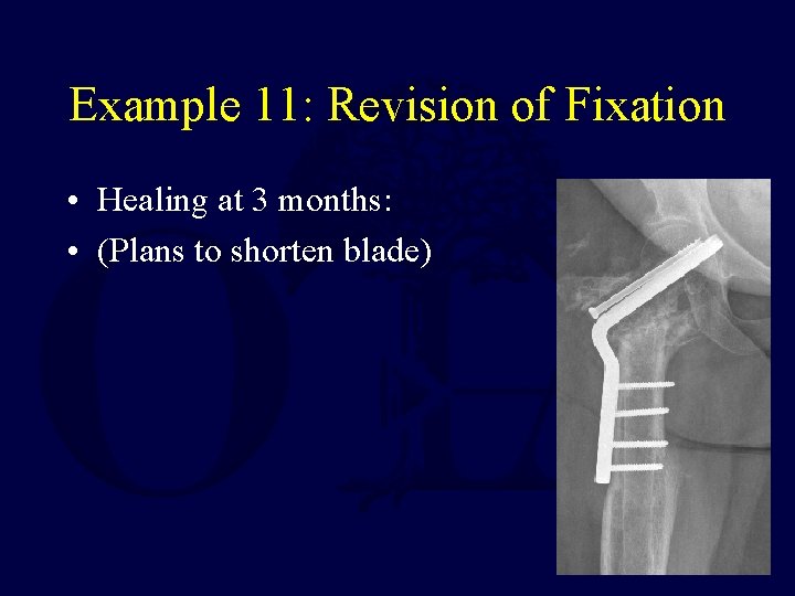 Example 11: Revision of Fixation • Healing at 3 months: • (Plans to shorten