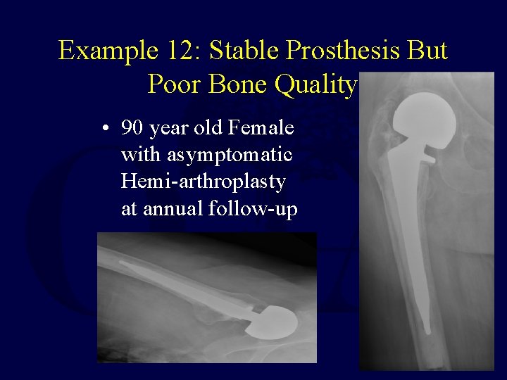 Example 12: Stable Prosthesis But Poor Bone Quality • 90 year old Female with
